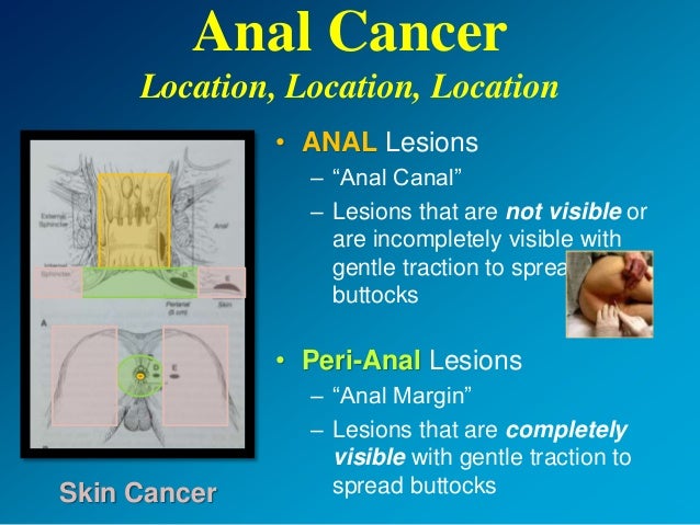 photos of anal lesions Photos of anal lesions